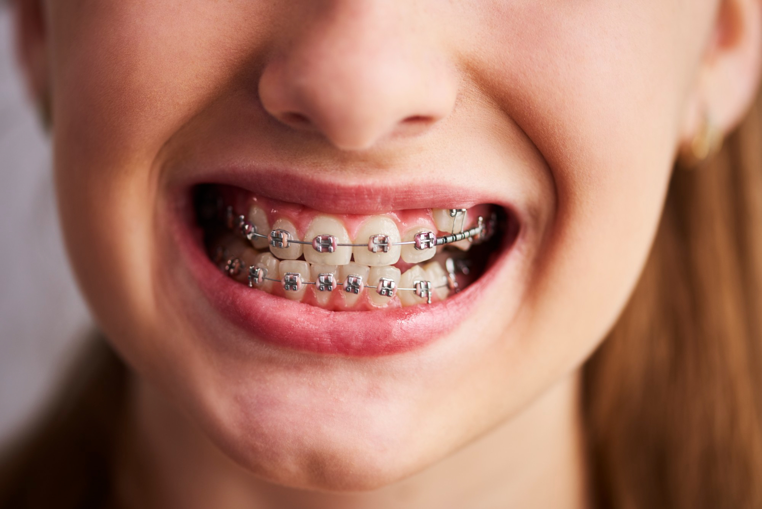 Braces for Teens